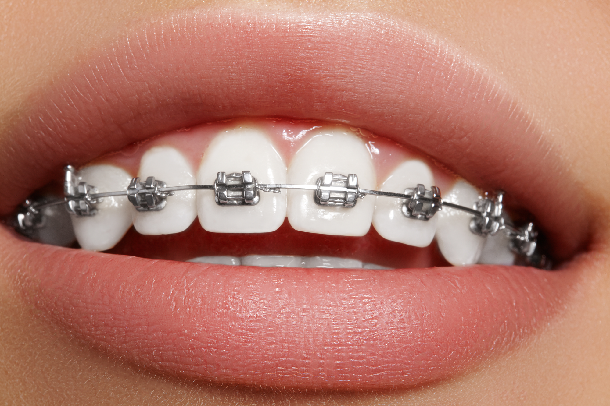 Traditional Braces Ackerman & Towson Dentistry Brentwood Ca